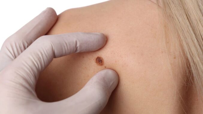 Il promettente vaccino personalizzato a mRna contro il melanoma